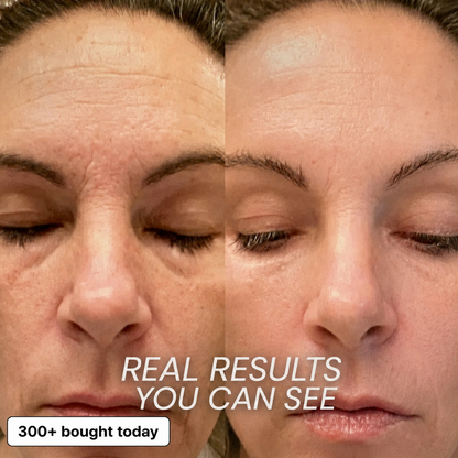 Real forehead and face results
